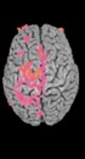 Current Infection Control Recommendations for Prion Disease; A Difficult Problem for the Deployed Personnel of the Armed Forces